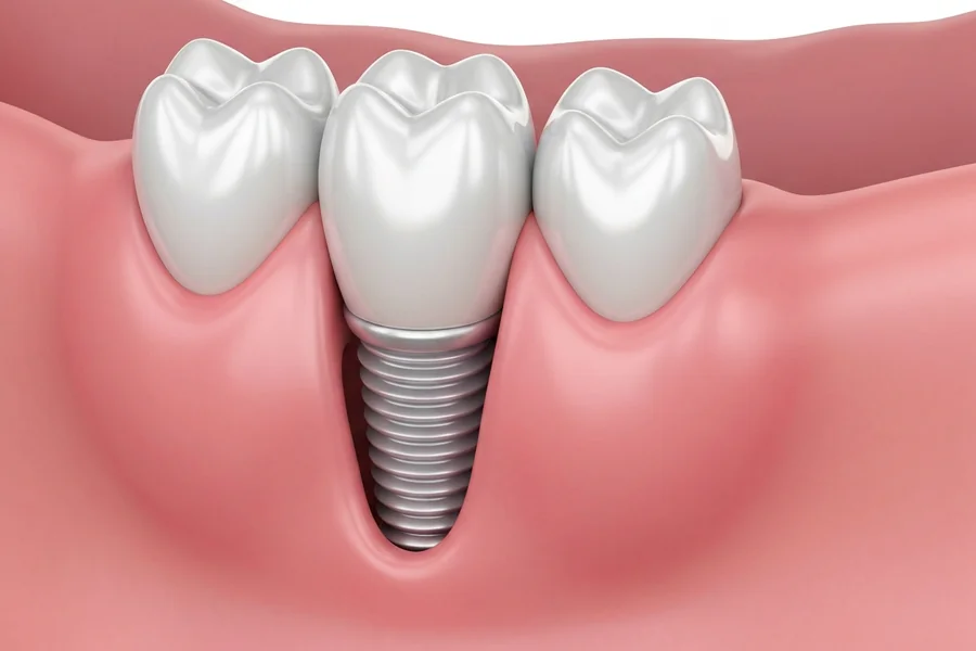 What to Expect During Your Single Tooth Implant Procedure