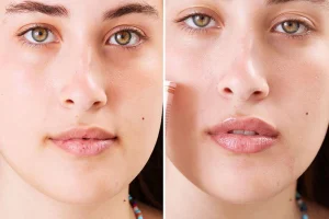 Lip Plumping